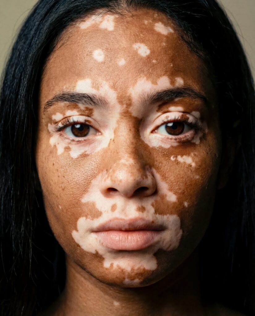 Image of a dermatologist consulting with a patient about vitiligo cream options