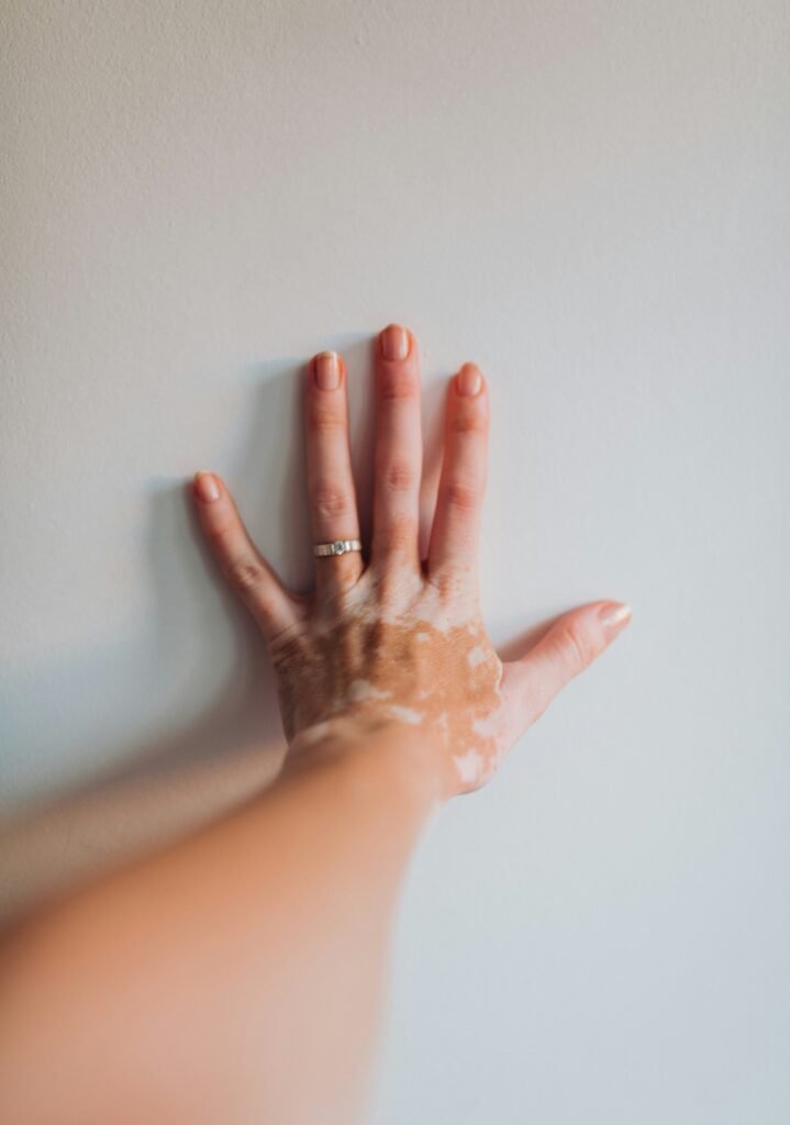 Image of a variety of vitiligo creams including corticosteroid and natural options
